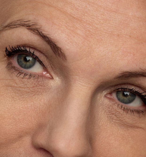 Skaneateles Eyelid Lift model Skaneateles Eyelid Lift model